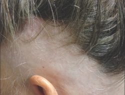 Apa Itu Alopecia Areata?