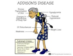 Apa Itu Addison’s Disease?