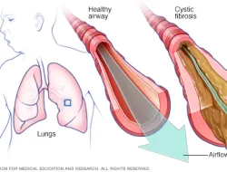Cystic Fibrosis, Gangguan Paru yang Perlu Diwaspadai