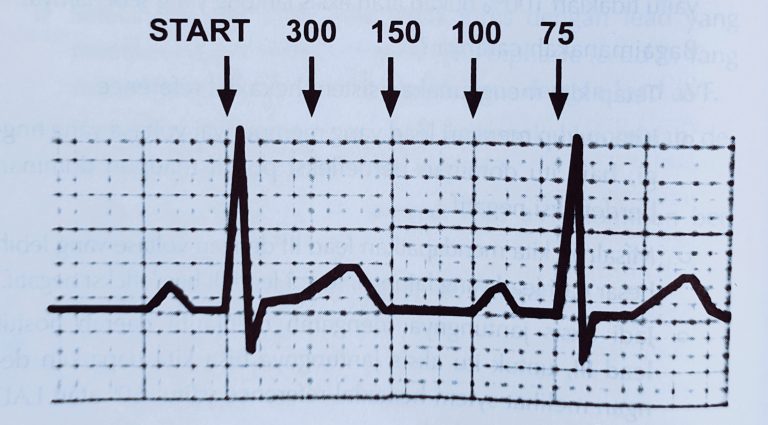 3 Cara Menghitung Frekuensi Jantung (Heart Rate) - Mediaperawat.id