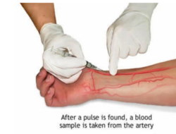 SPO Keperawatan : Pengambilan Sampel Darah Arteri (AGD)