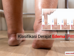 Klasifikasi Derajat Edema (Pitting)