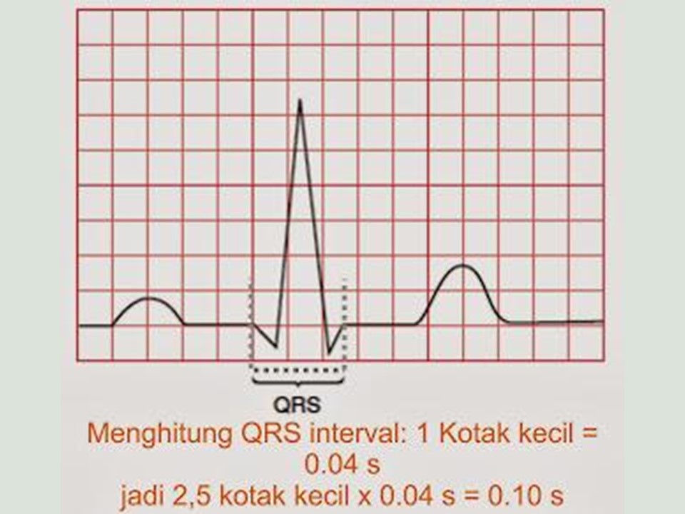 Cara Membaca EKG dengan Mudah (1)