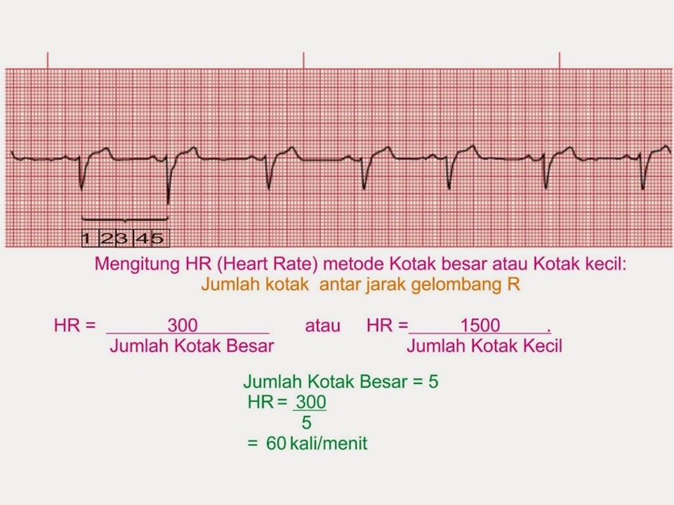 Cara Membaca EKG dengan Mudah (3)