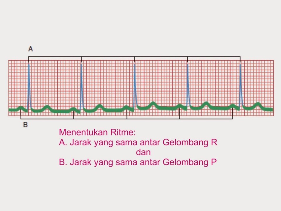 Cara Membaca EKG dengan Mudah (4)