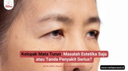 Kelopak Mata Turun_Ptosis