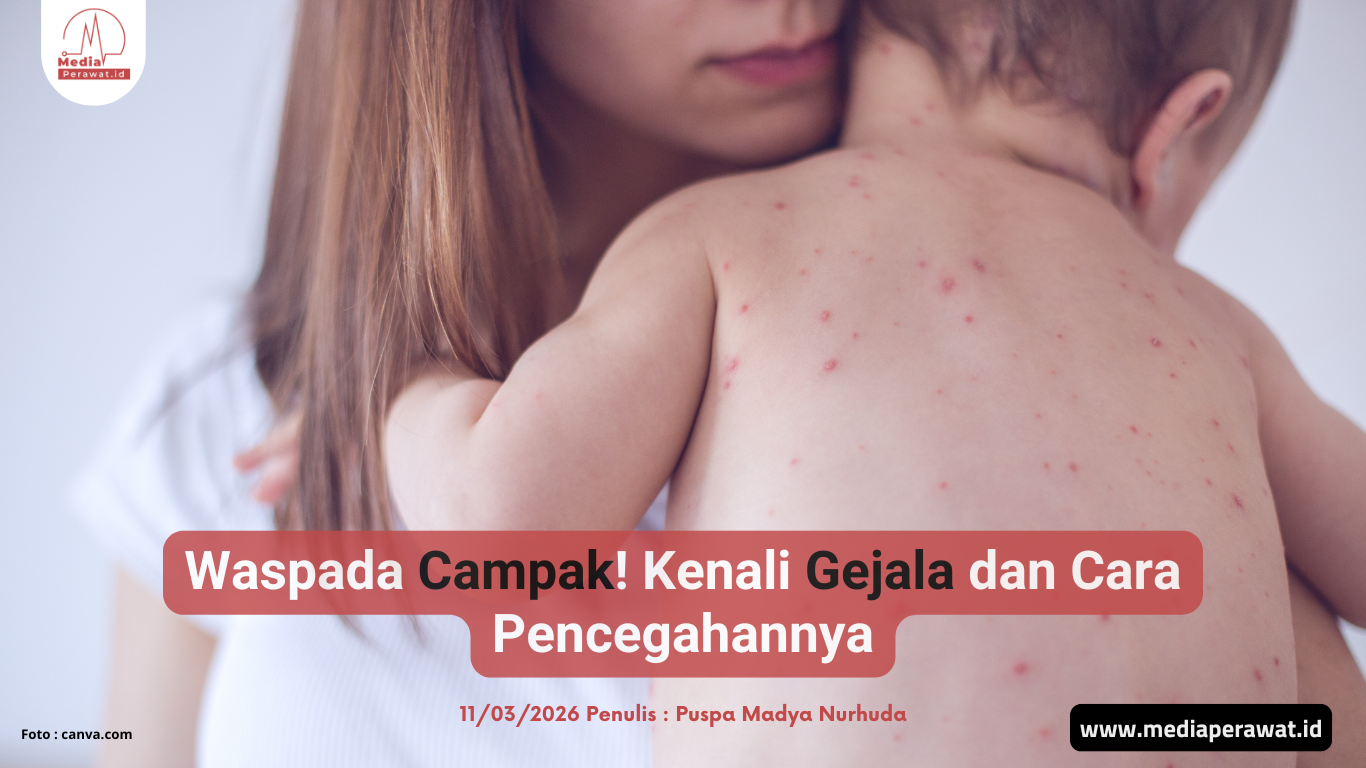 Gejala dan Cara Pencegahan Campak